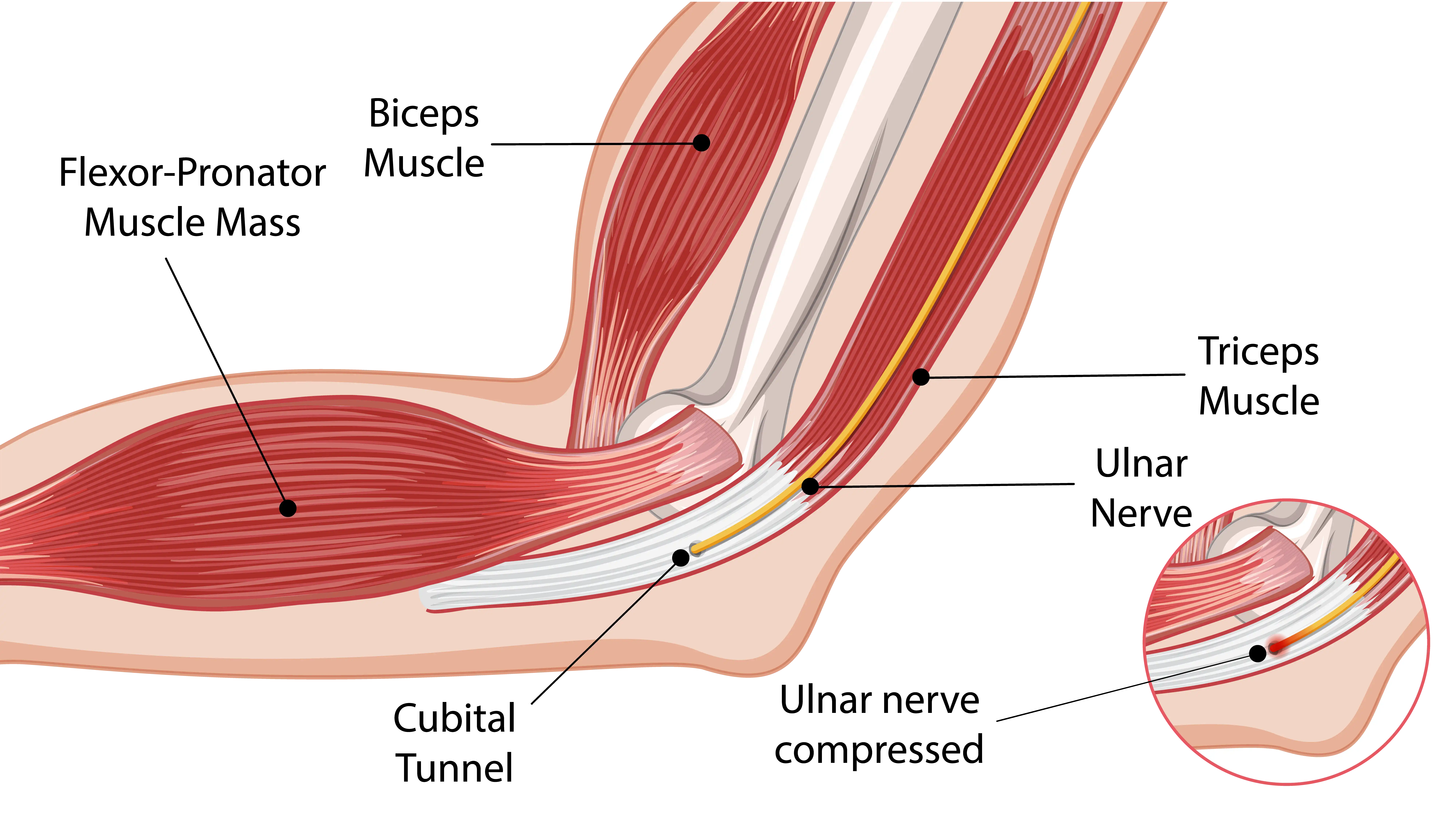 Anatomical Graphic Compressed Ulnar Nerve