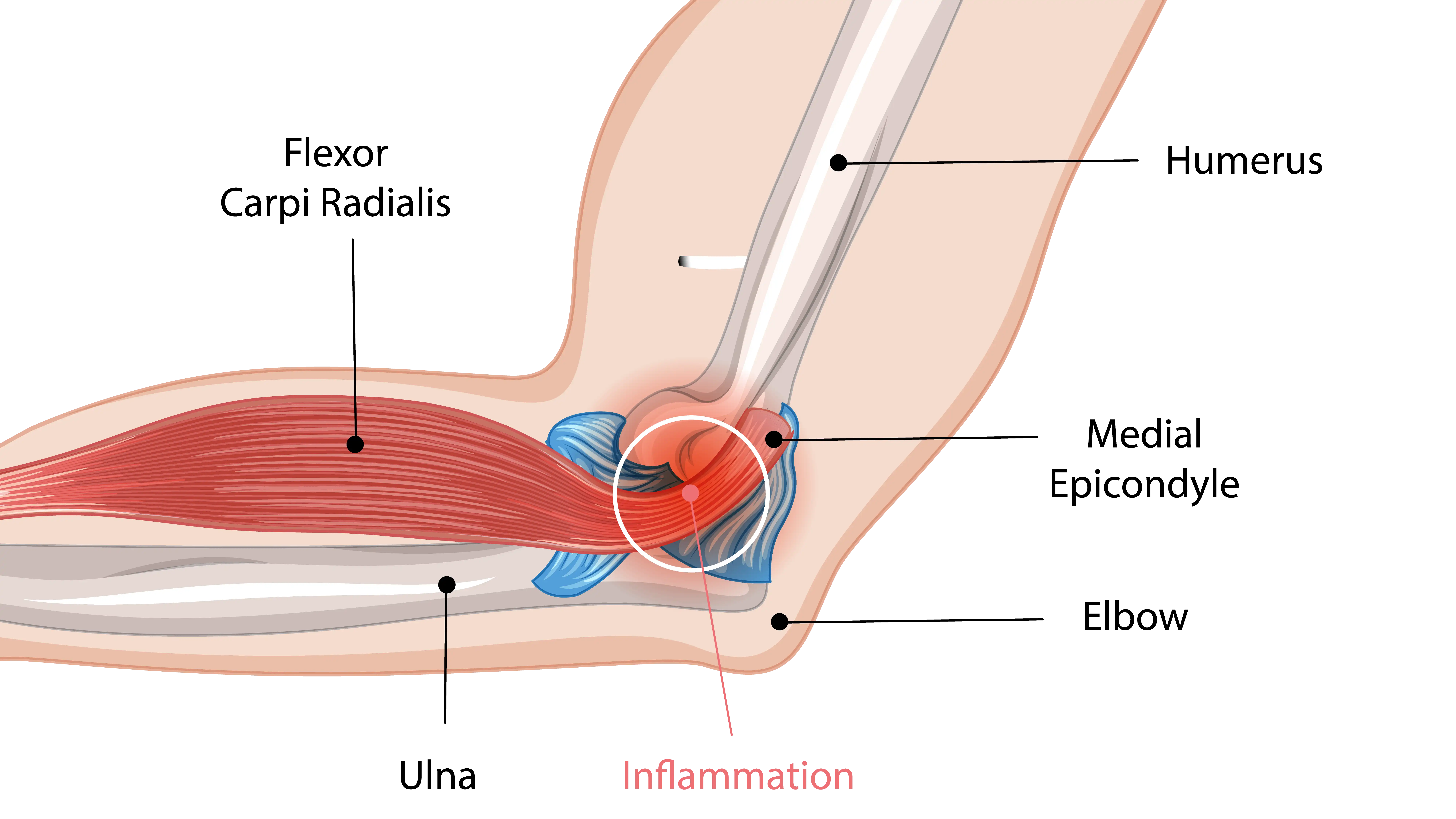 Anatomical Graphic of Golfers Elbow