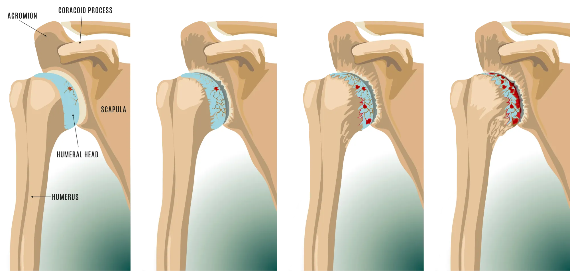 Anatomical graphic of shoulder Arthritis