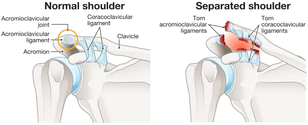 ACJoint A diagram explaining the difference between a normal and separated shoulder, focusing on the torn ligaments.