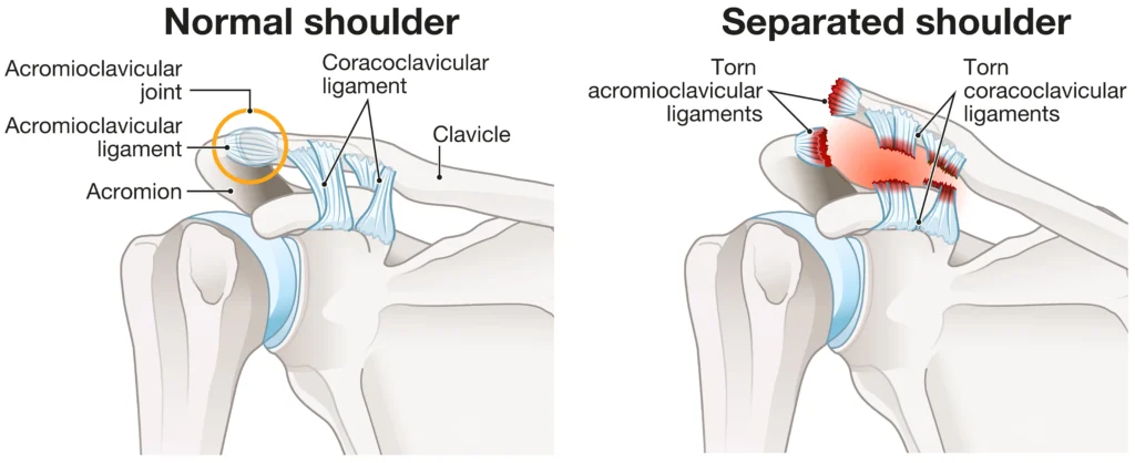 acjoint A diagram explaining the difference between a normal and separated shoulder, focusing on the torn ligaments.