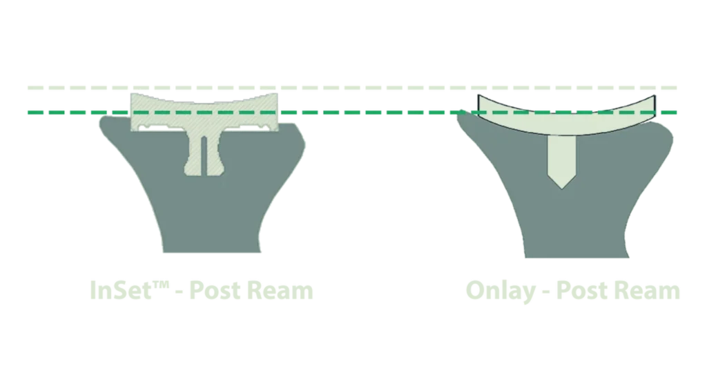 glenoid loosening diagram SI
