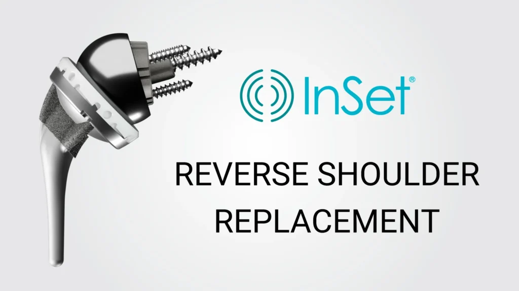 Implant Images RSA InSet® technology for reverse shoulder replacement procedures.