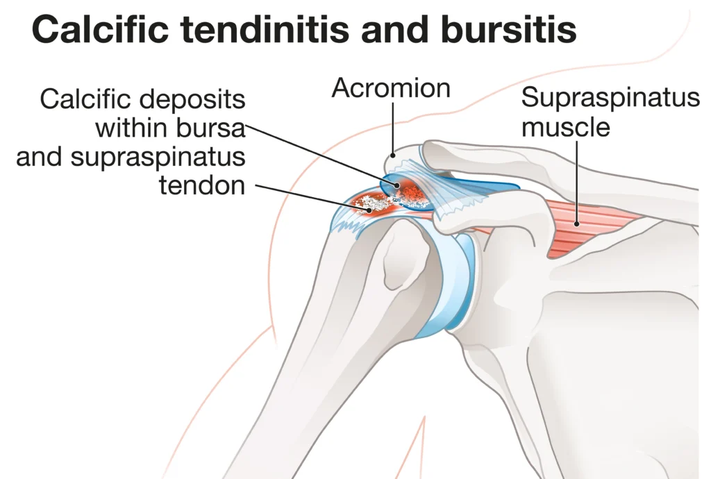 Calcific_tendinits Diagram of calcific tendinitis and bursitis in the shoulder, showing calcium deposits near the supraspinatus tendon and acromion.