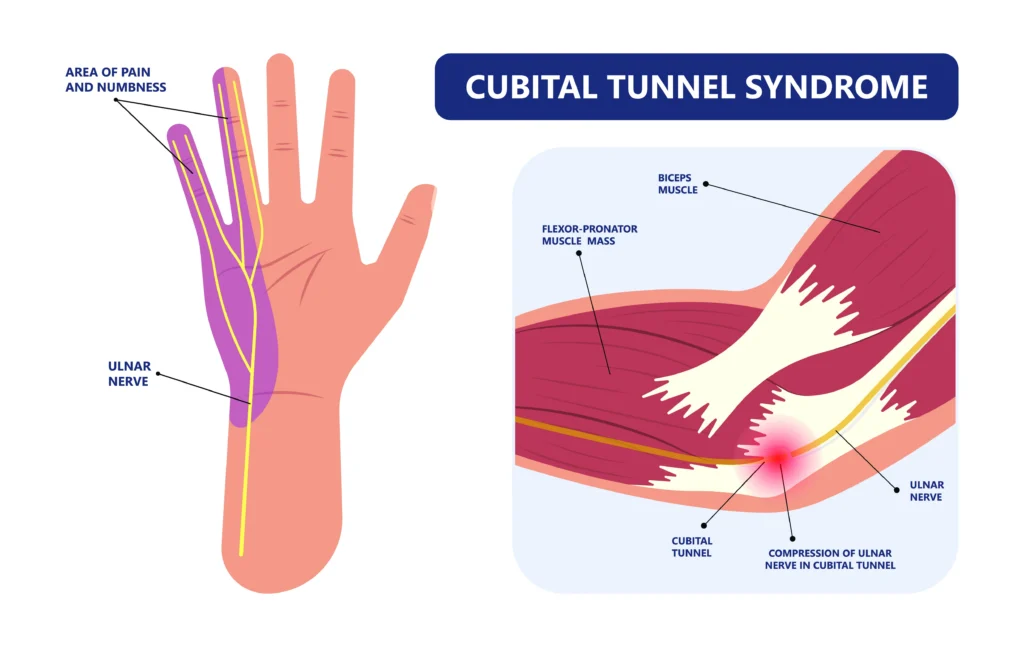 What is cubital tunnel syndrome diagram showing ulnar nerve compression at the elbow and numbness in the ring and small fingers