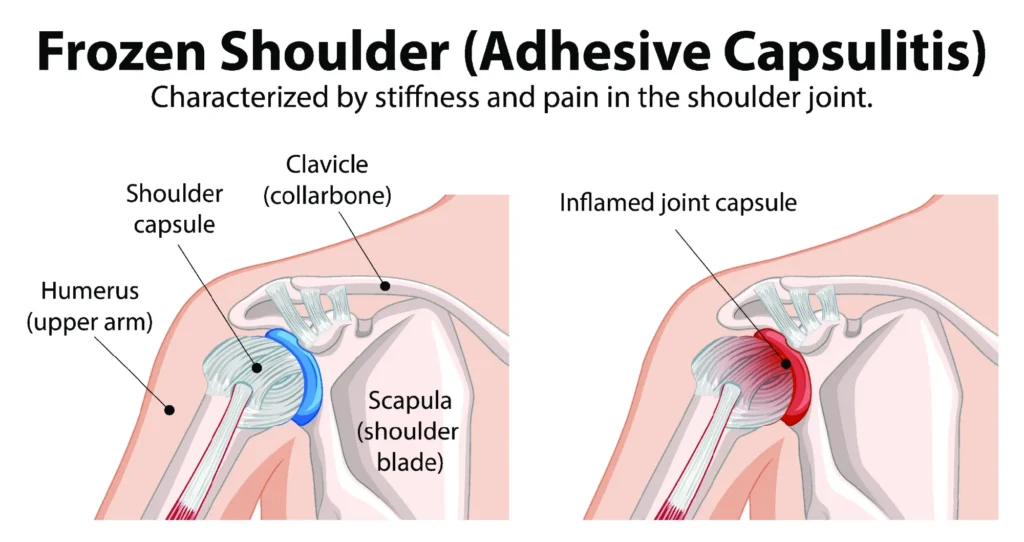 anatomically accurate frozen shoulder diagram, comparing a healthy and injured shoulder.