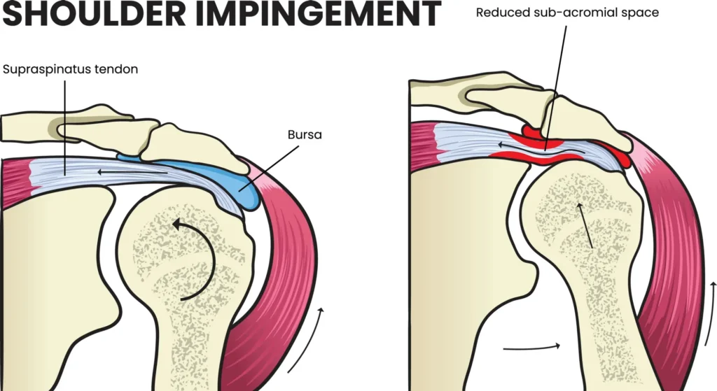 shoulder impingement diagram compared against a healthy shoulder