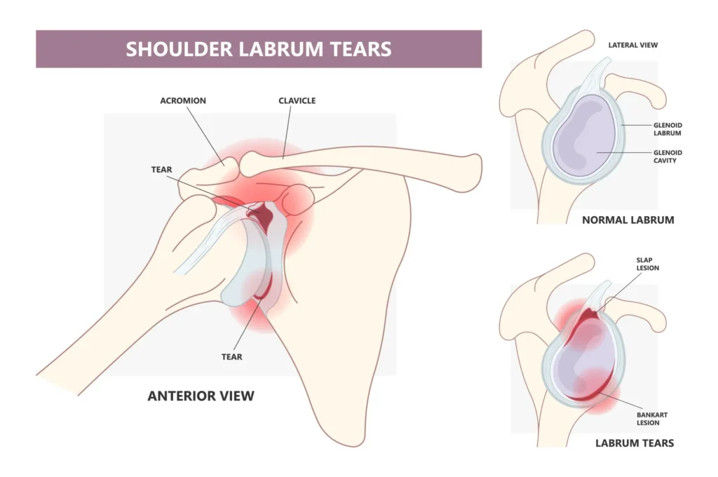 shoulder labral tear shoulder labral tears compared to a healthy shoulder