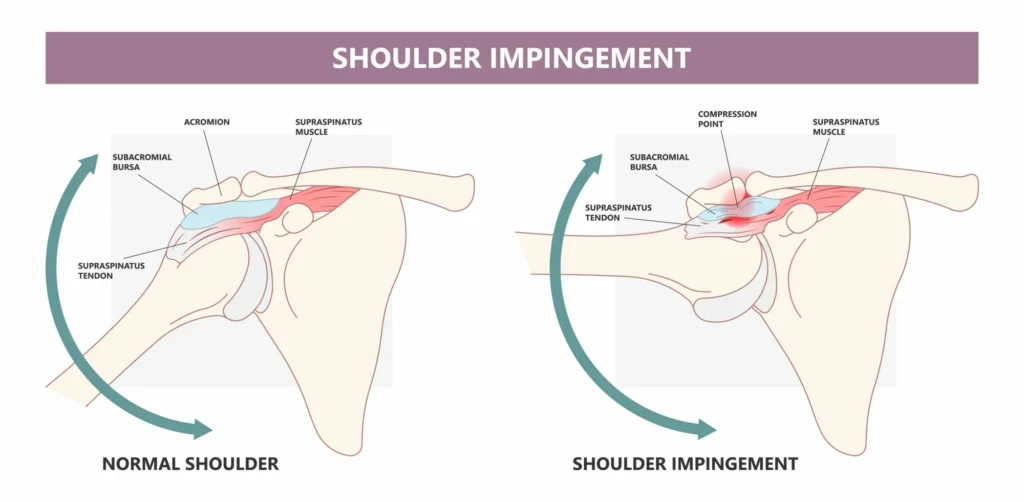 Shoulder impingement diagram.