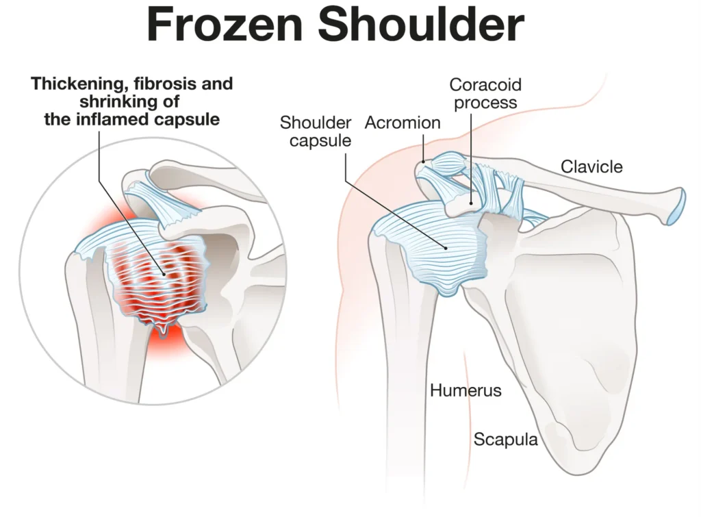 Diagram of a frozen shoulder