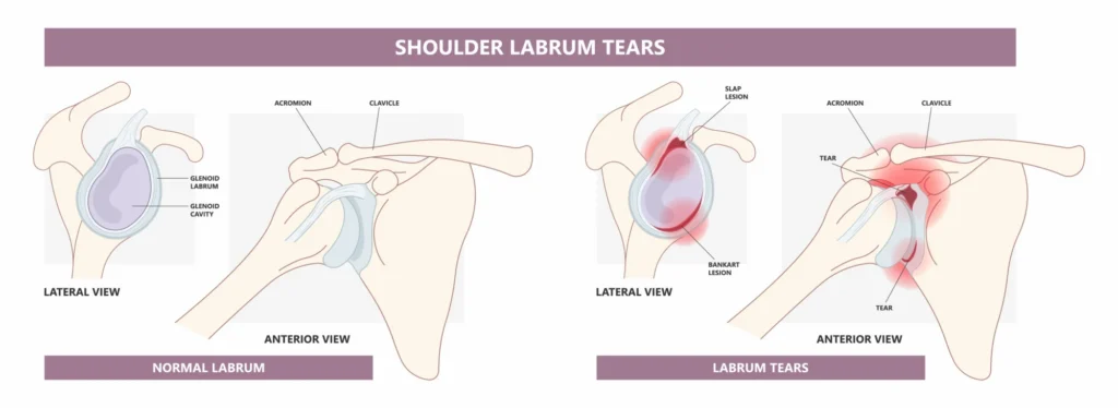 labral tear diagram
