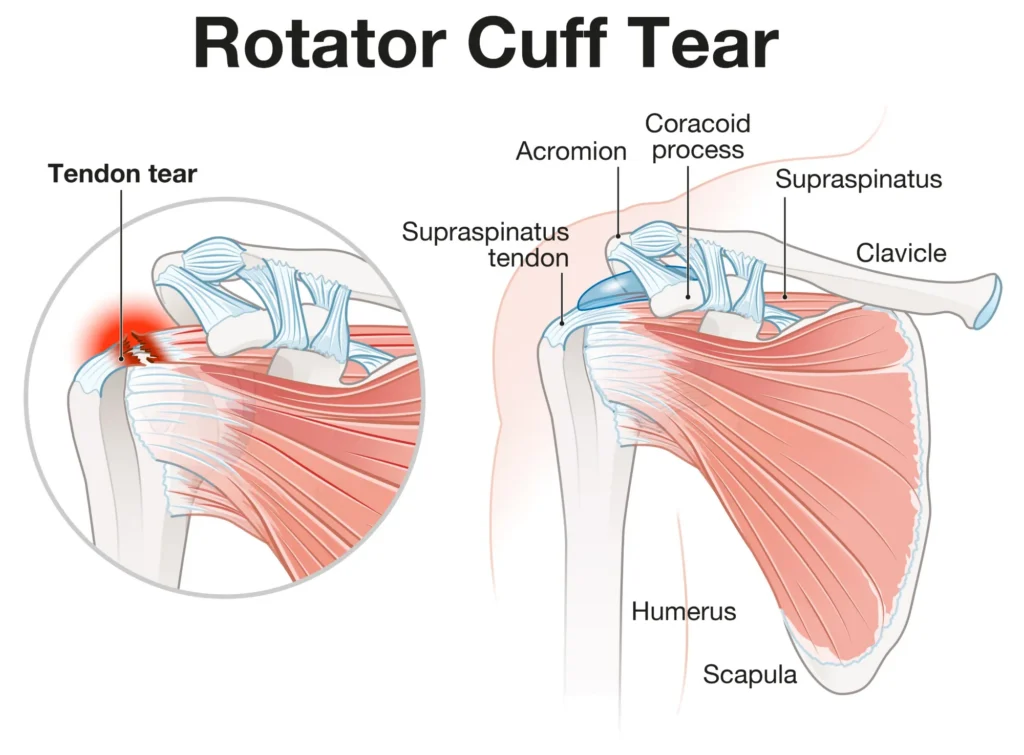 Diagram of a rotator cuff tear